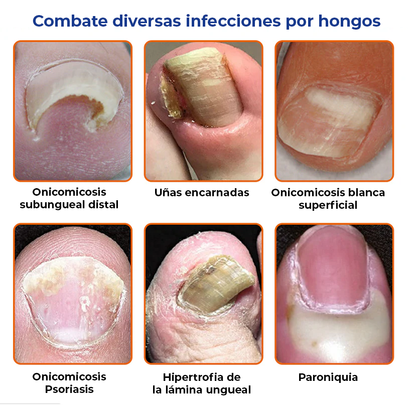[2X1] MyCare® |ELIMINA LOS HONGOS DE LAS UÑAS EN 5 DÍAS Y EVITA QUE APEREZCAN PARA SIEMPRE